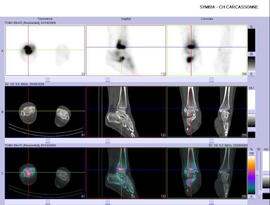 Fracture du pilon tibial droit