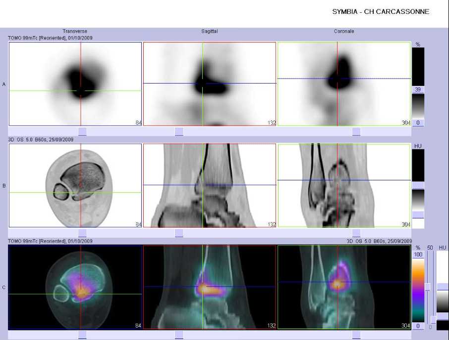 Fracture du pilon tibial droit
