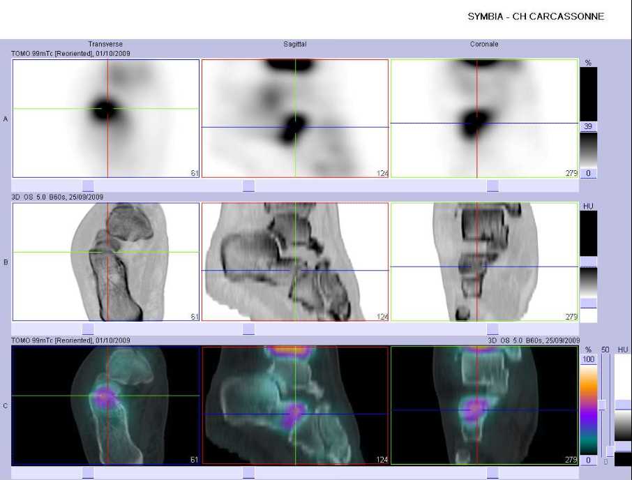 L&eacute;sion microtraumatique de l'articulation calcan&eacute;o cubo&iuml;dienne droite 