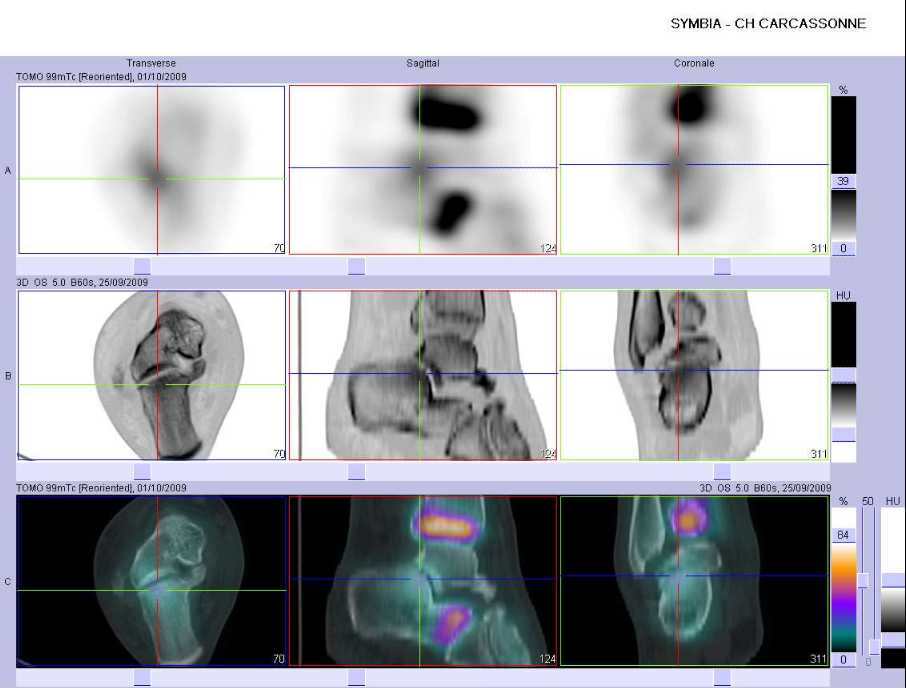 L&eacute;sion microtraumatique de l'articulation sous talienne post&eacute;rieure droite
