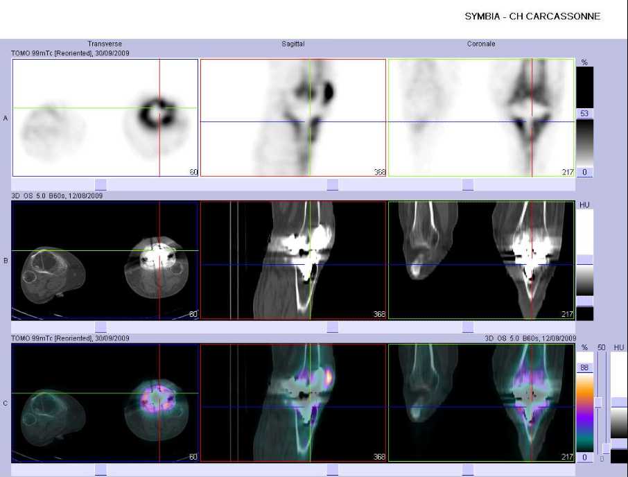 hyperfixation intense au contact de la composante tibiale de la PTG gauche