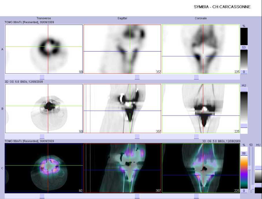 hyperfixation intense au contact de la composante tibiale de la PTG gauche