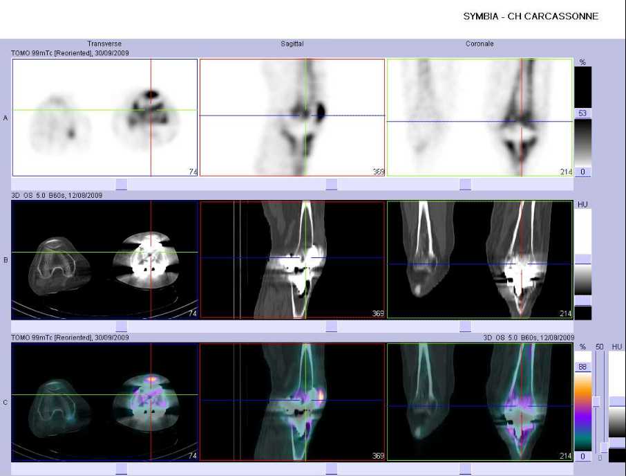 hyperfixation intense au contact de la composante f&eacute;morale et de la composante patellaire de la PTG gauche