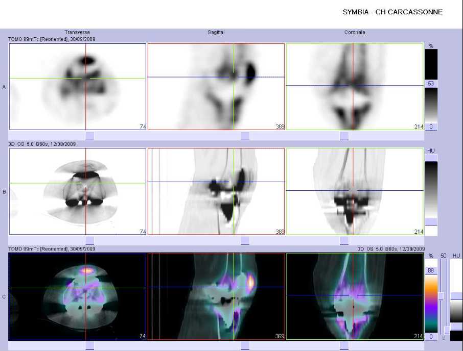 hyperfixation intense au contact de la composante f&eacute;morale et de la composante patellaire de la PTG gauche