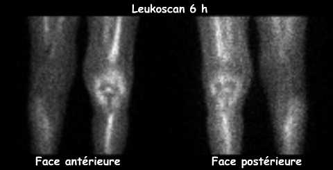 Leukoscan 6&egrave;me heure