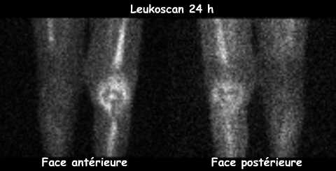 Leukoscan 24&egrave;me heure