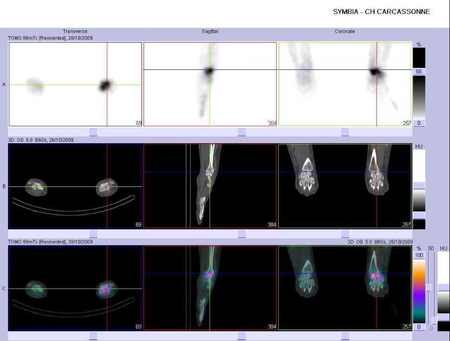 Arthrose de la surface articulaire inf&eacute;rieure du radius gauche