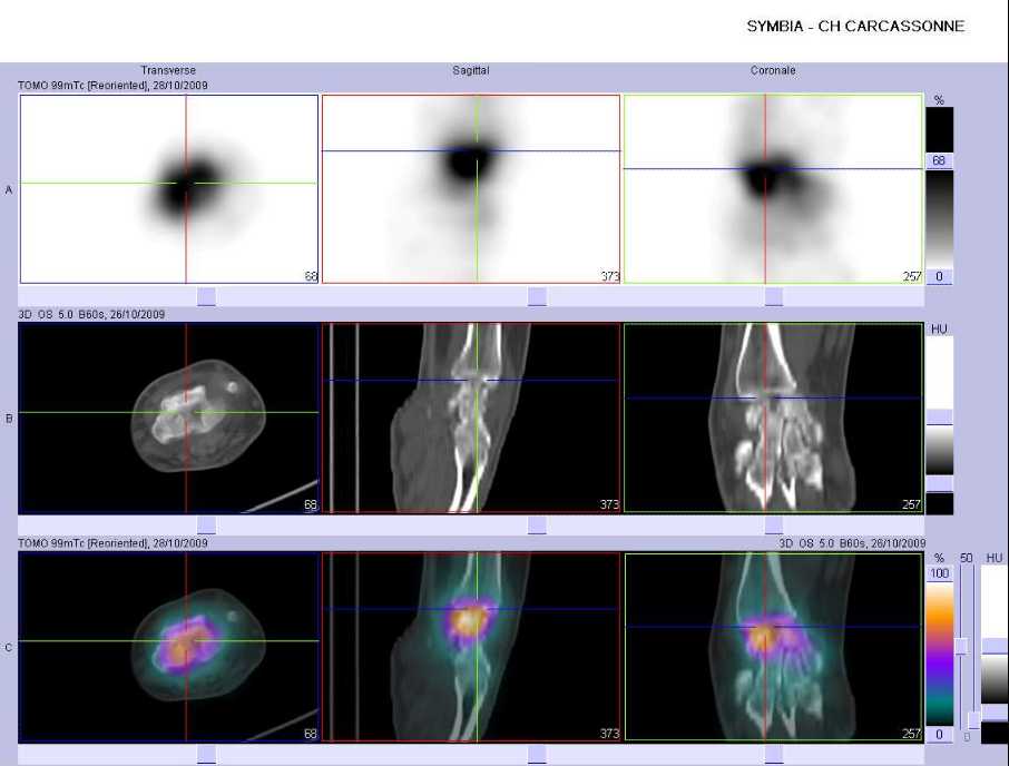 Arthrose de la surface articulaire inf&eacute;rieure du radius gauche