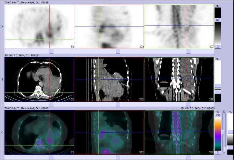 Epanchement pleural gauche