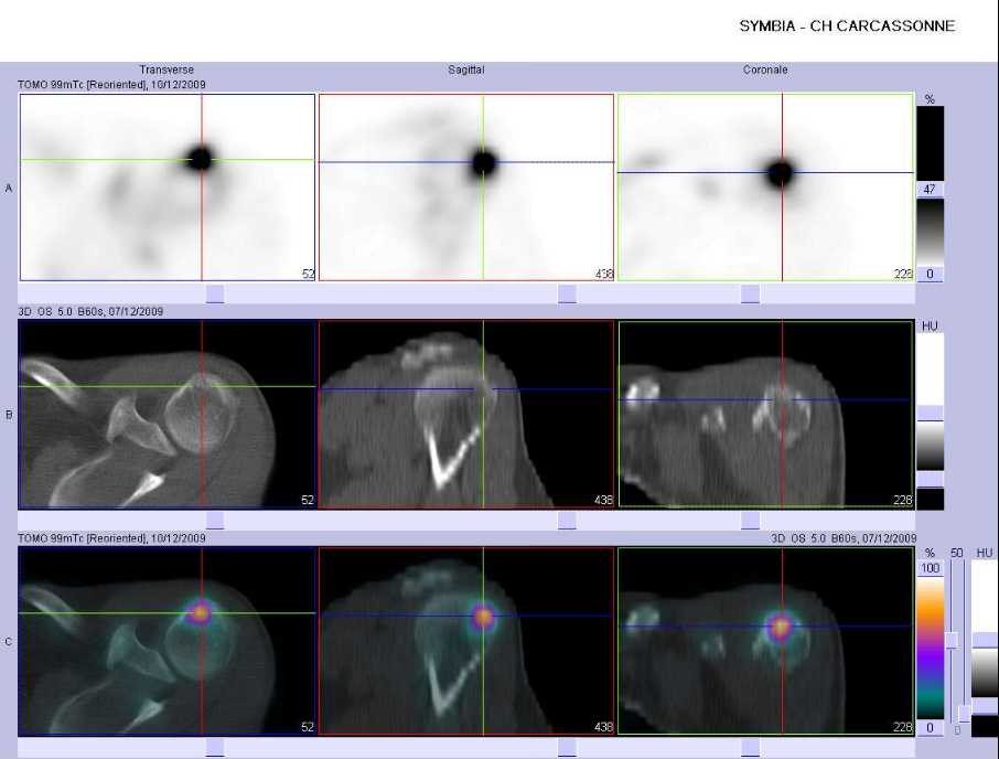 Tendinopathie d'insertion du supra &eacute;pineux gauche sur le tubercule majeur