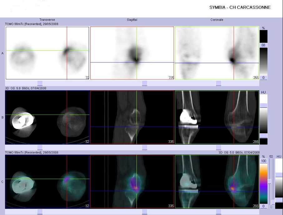 Arthrose du plateau tibial interne gauche