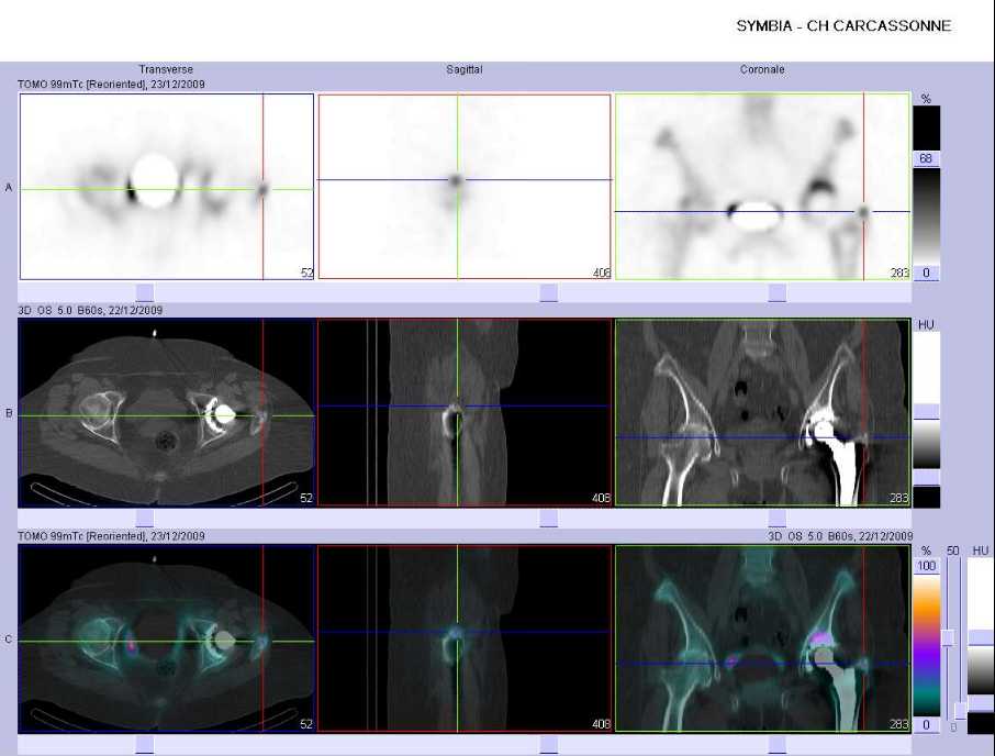Pathologie d'insertion sur le grand trochanter gauche