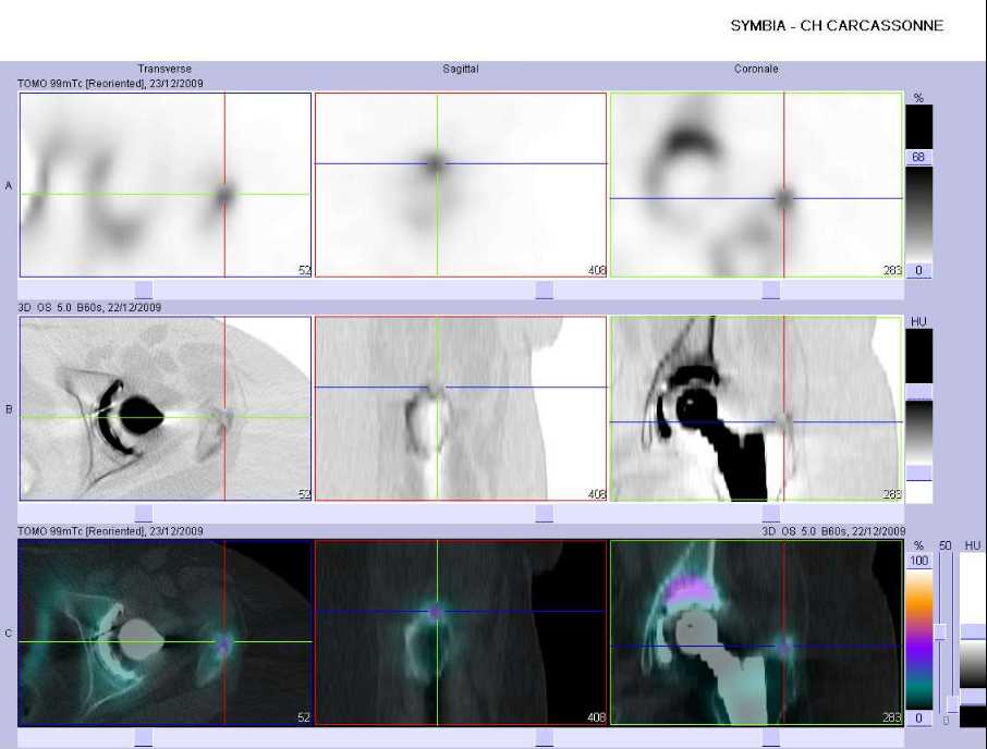 Pathologie d'insertion sur le grand trochanter gauche