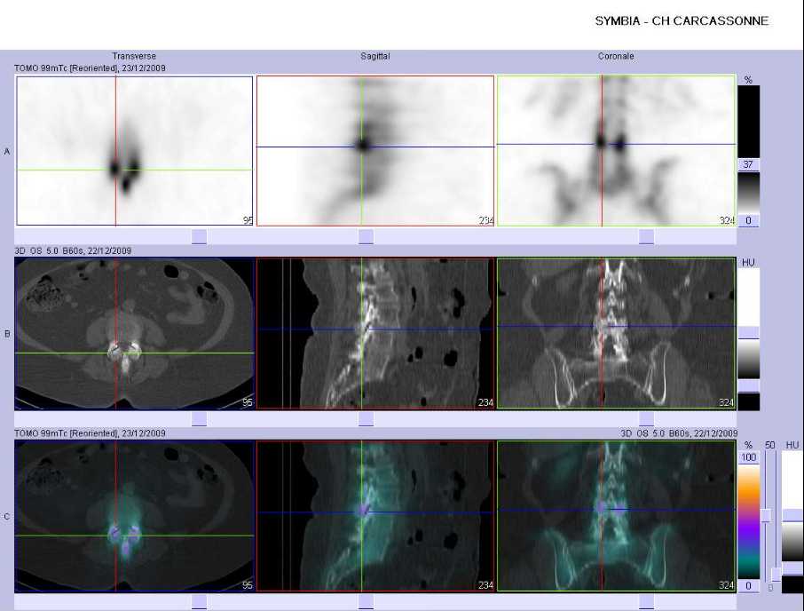 Arthrose des articulaires post&eacute;rieures de L3-L4