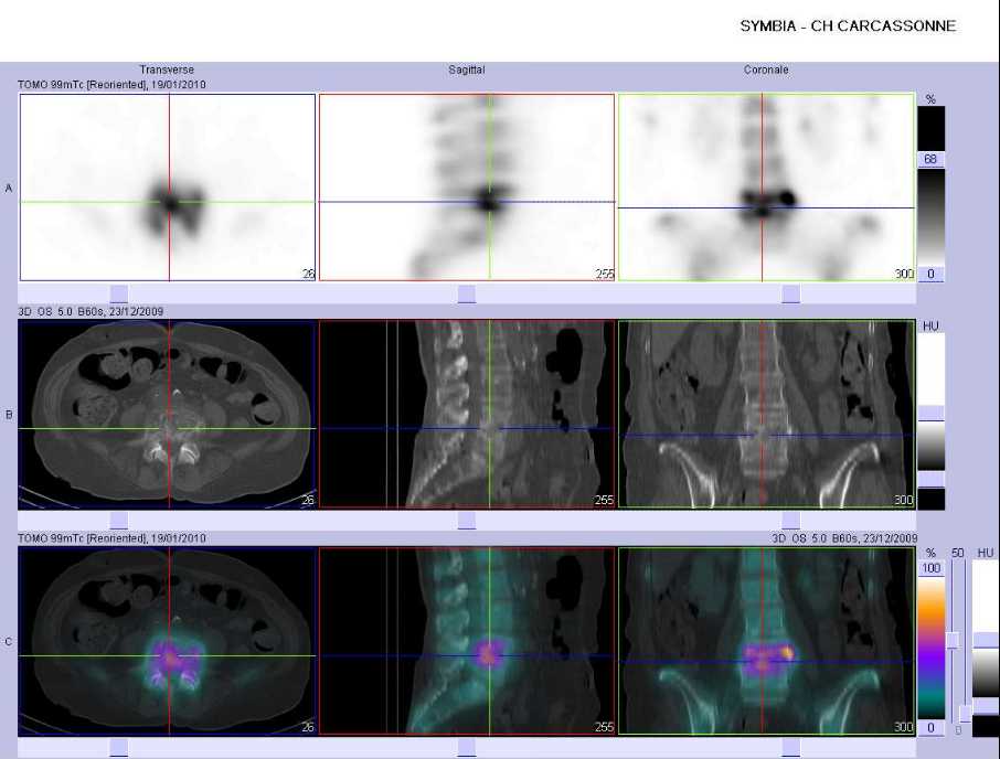Spondylodiscite infectieuse L4-L5