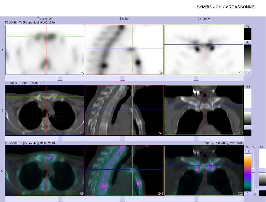 Ost&eacute;ite condensante du manubrium sternal et arthrite de la premi&egrave;re articulation sterno-costale droite et gauche