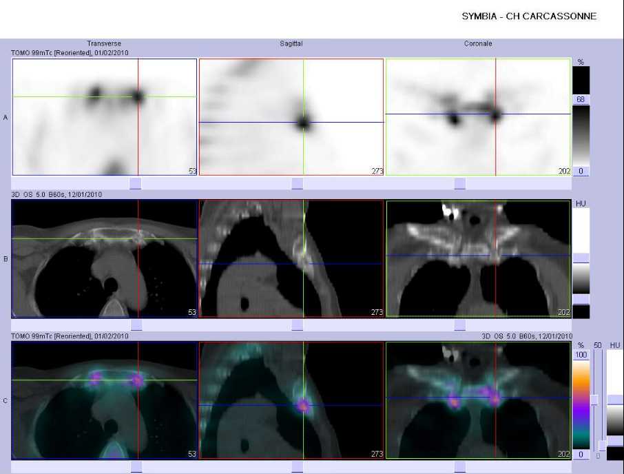 Ost&eacute;ite condensante du manubrium sternal et arthrite de la premi&egrave;re articulation sterno-costale droite et gauche