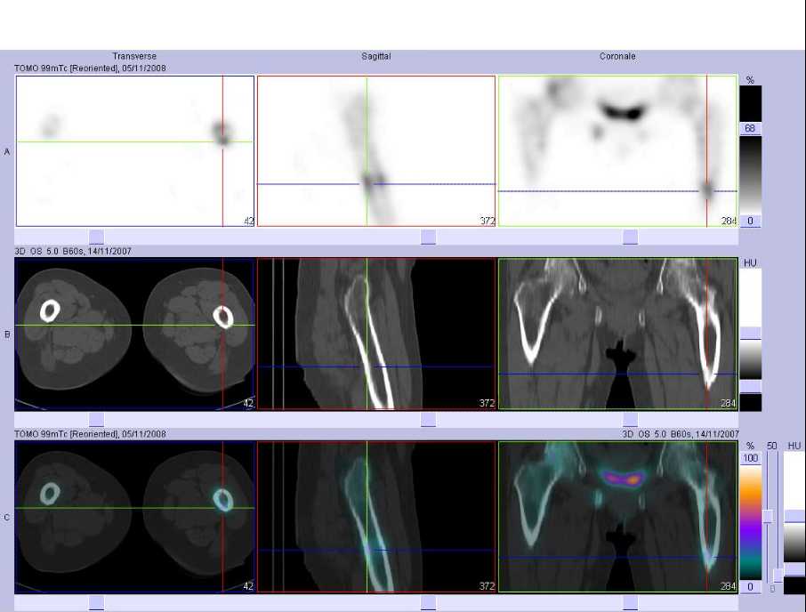 Fracture du 1/3 sup&eacute;rieur du f&eacute;mur gauche