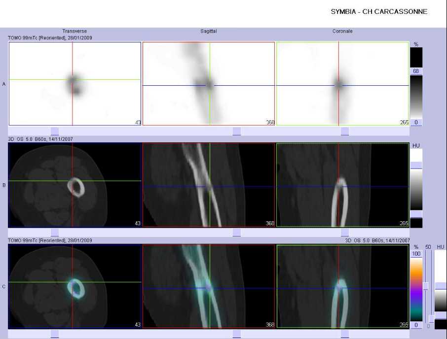 Fracture du 1/3 sup&eacute;rieur du f&eacute;mur gauche