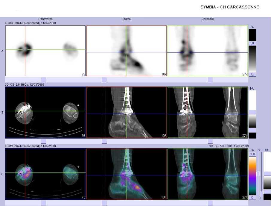 Fracas du pilon tibial droit op&eacute;r&eacute;