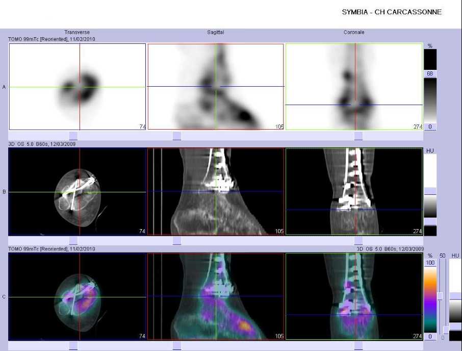 Fracas du pilon tibial droit op&eacute;r&eacute;