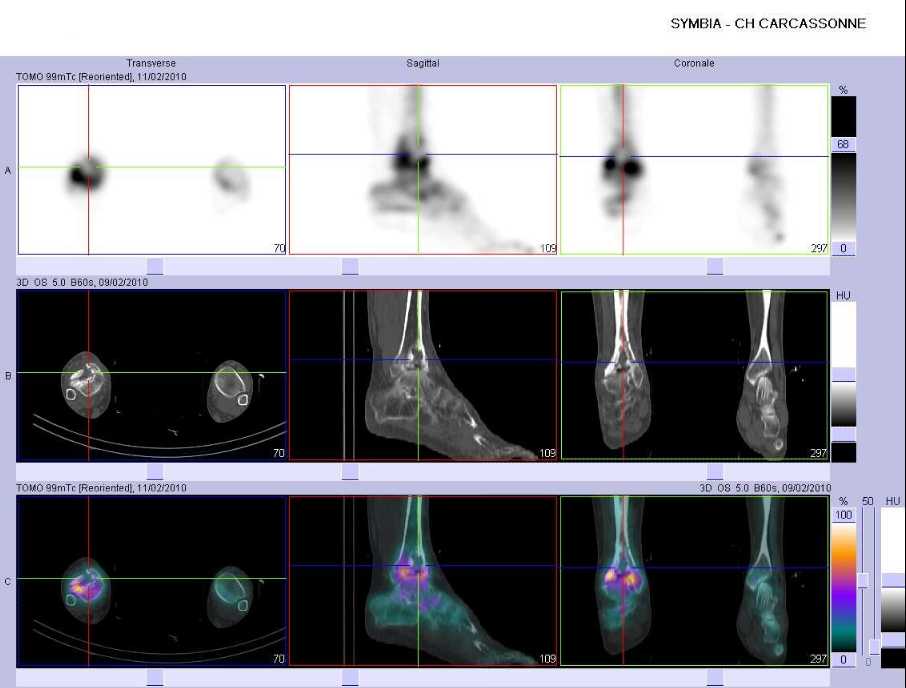 Eclatement du pilon tibial droit