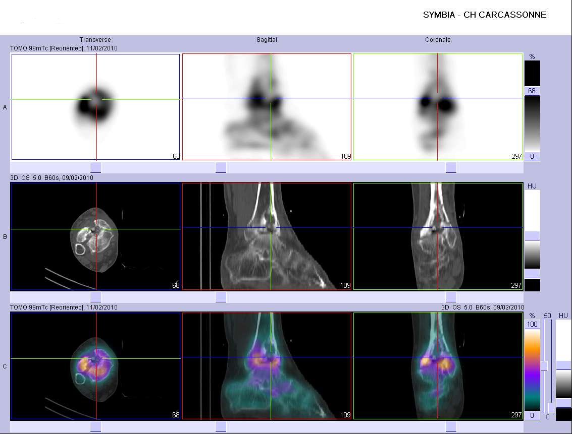 Eclatement du pilon tibial droit