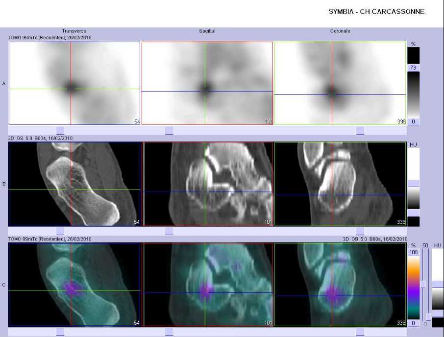 Probable contusion osseuse du corps du calcaneus droit