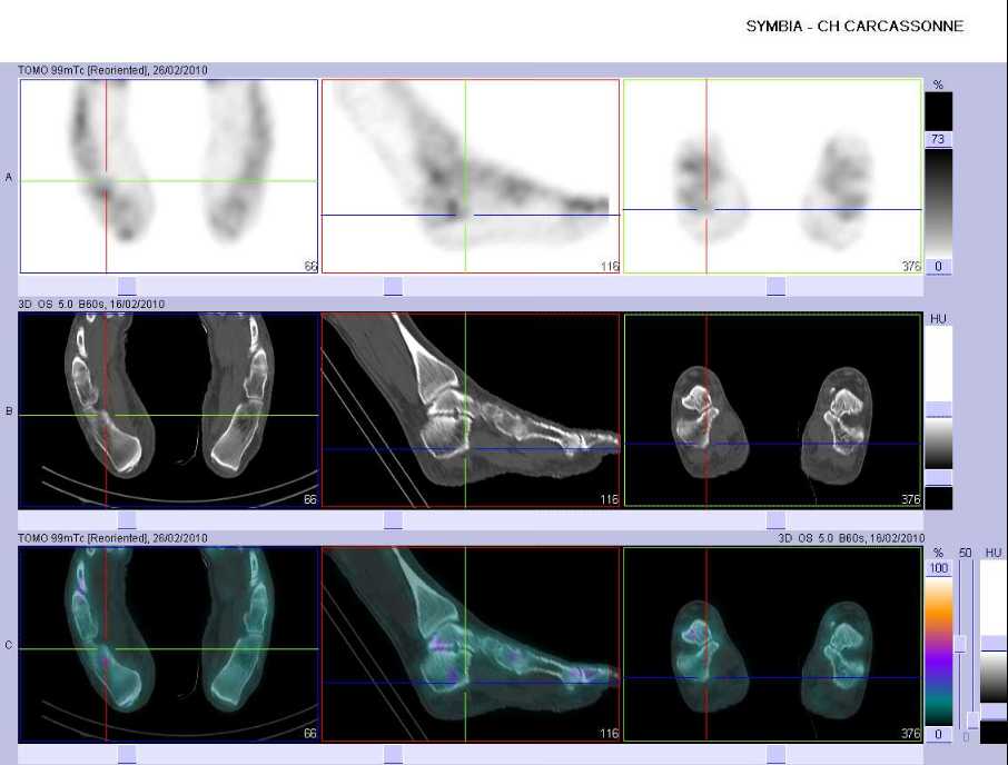 Absence d'inflammation de l'insertion calcan&eacute;enne de l'apon&eacute;vrose plantaire droite