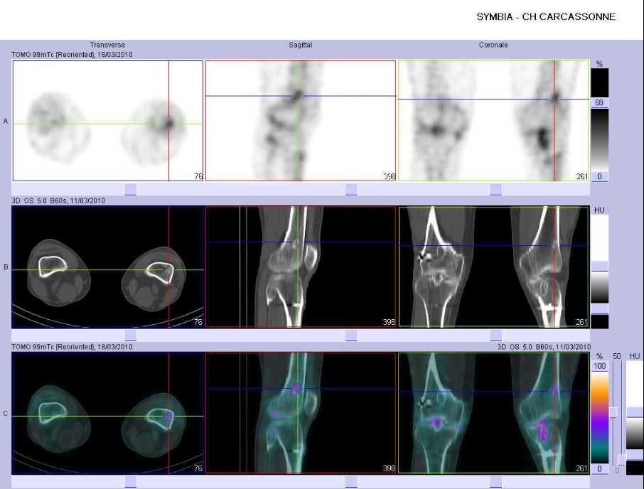 Ligamentoplastie gauche r&eacute;cente 