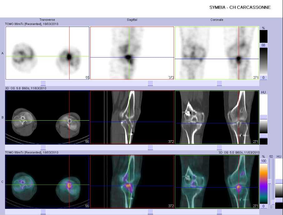 Ligamentoplastie gauche r&eacute;cente 
