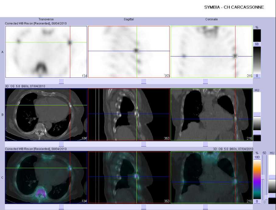 L&eacute;sions costales ost&eacute;olytiques ou ost&eacute;ocondensantes