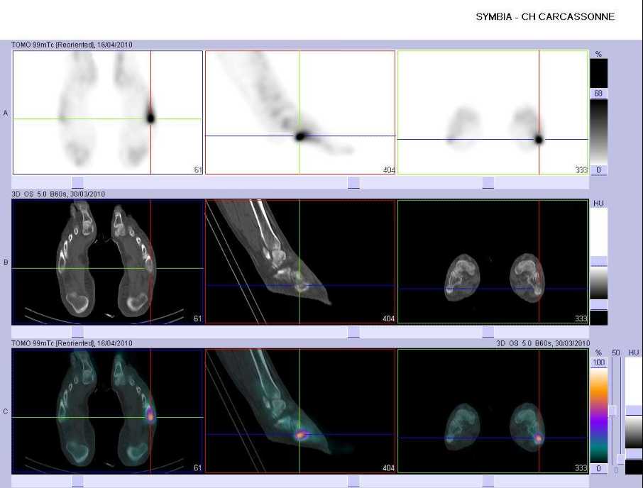 Fracture de la base du 5&egrave;me m&eacute;tatarsien gauche