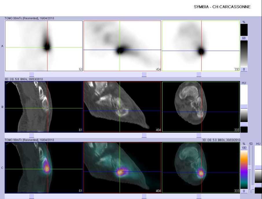 Fracture de la base du 5&egrave;me m&eacute;tatarsien gauche