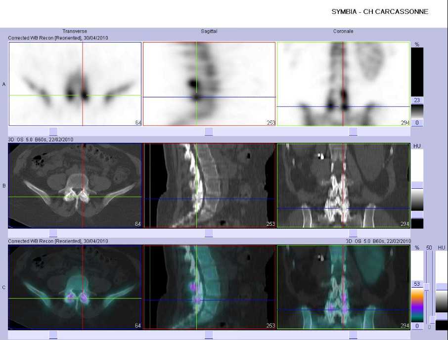 Syndrome facettaire bilat&eacute;ral de L5