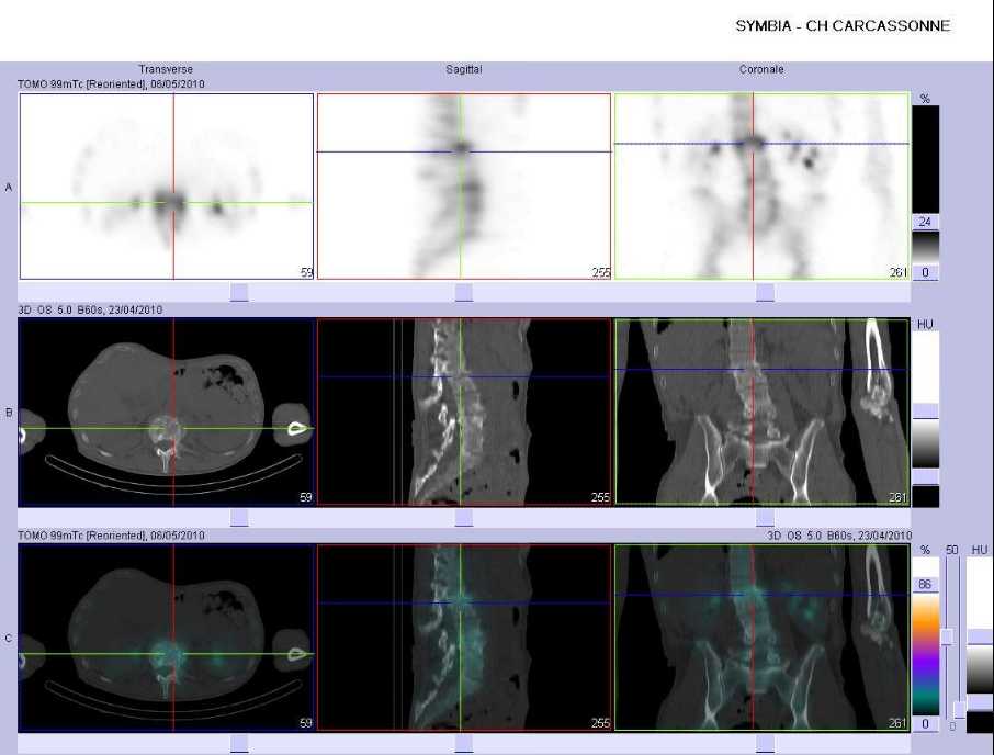 Spondylodiscite infectieuse L1-L2