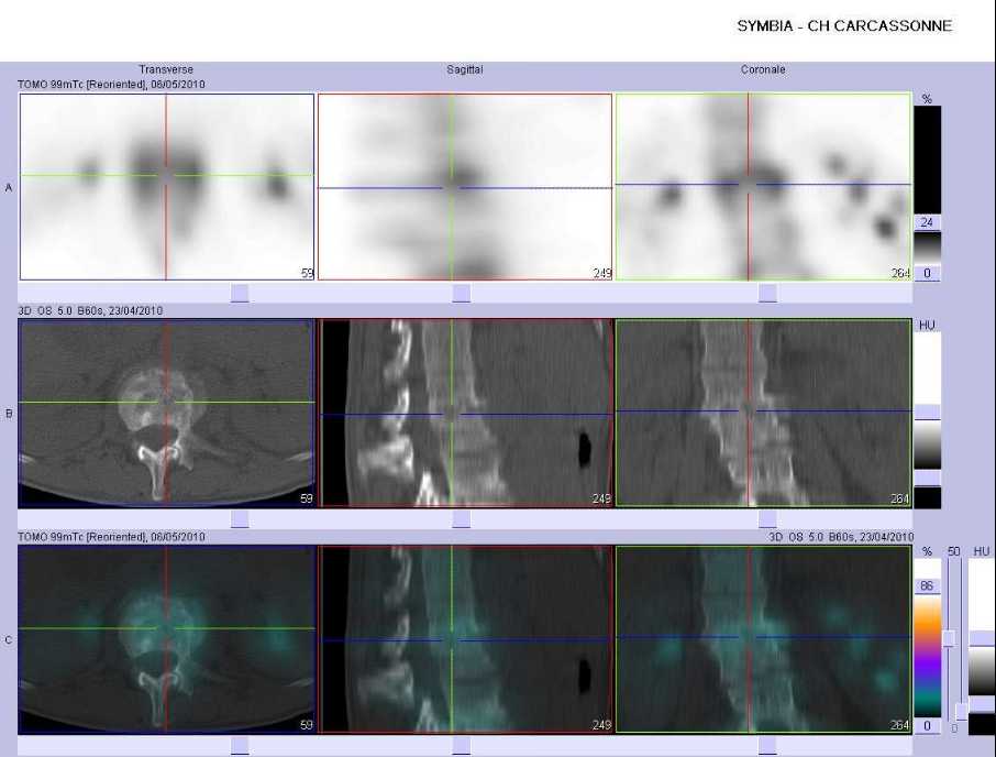 Spondylodiscite infectieuse L1-L2