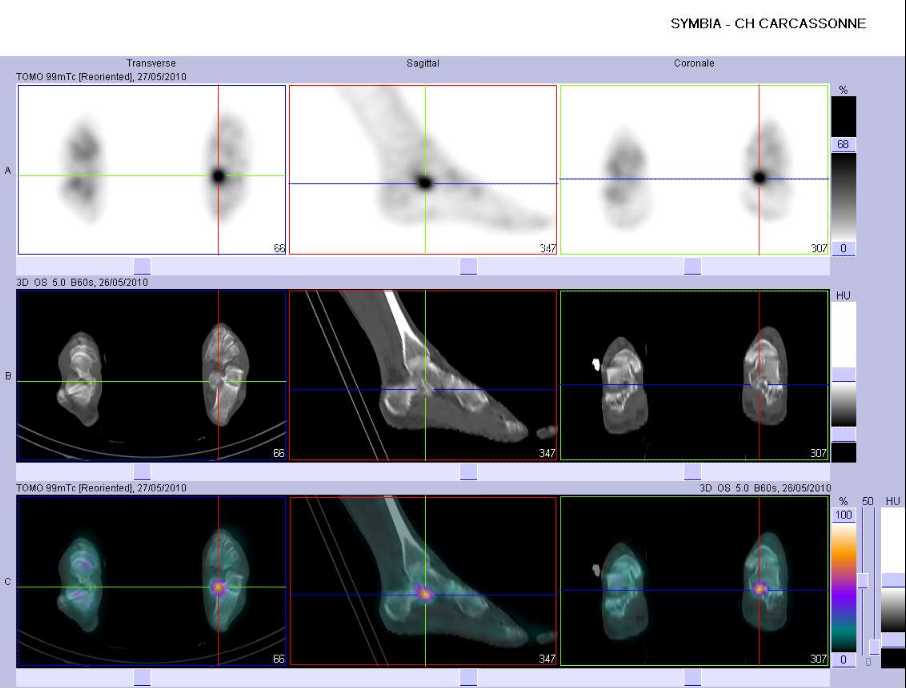 Fracture de fatigue du sustentaculum tali gauche
