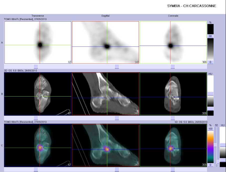 Fracture de fatigue du sustentaculum tali gauche