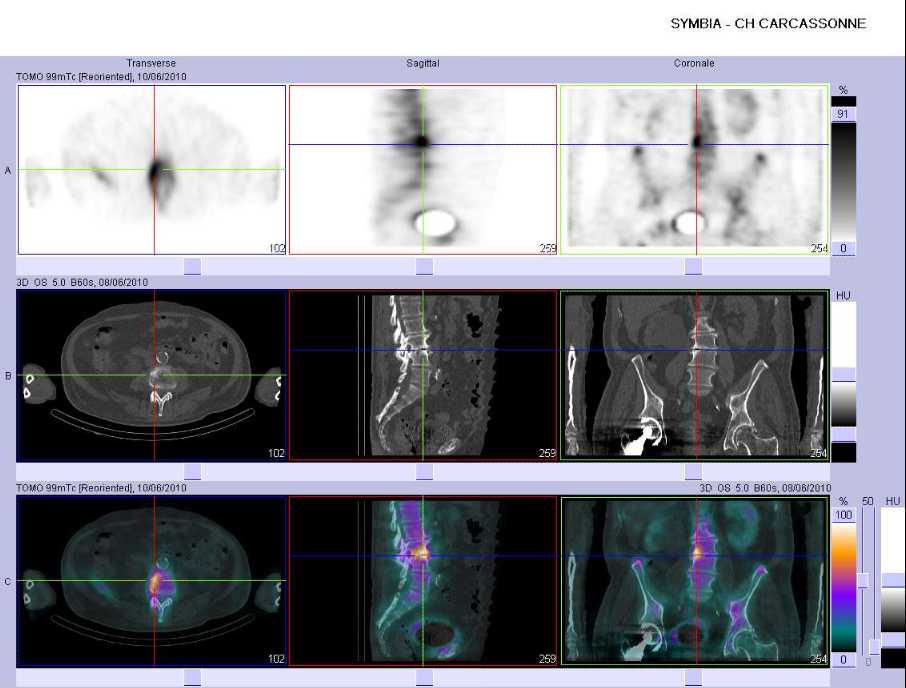 Discopathie arthrosique L3-L4, lat&eacute;ralis&eacute;e &agrave; droite