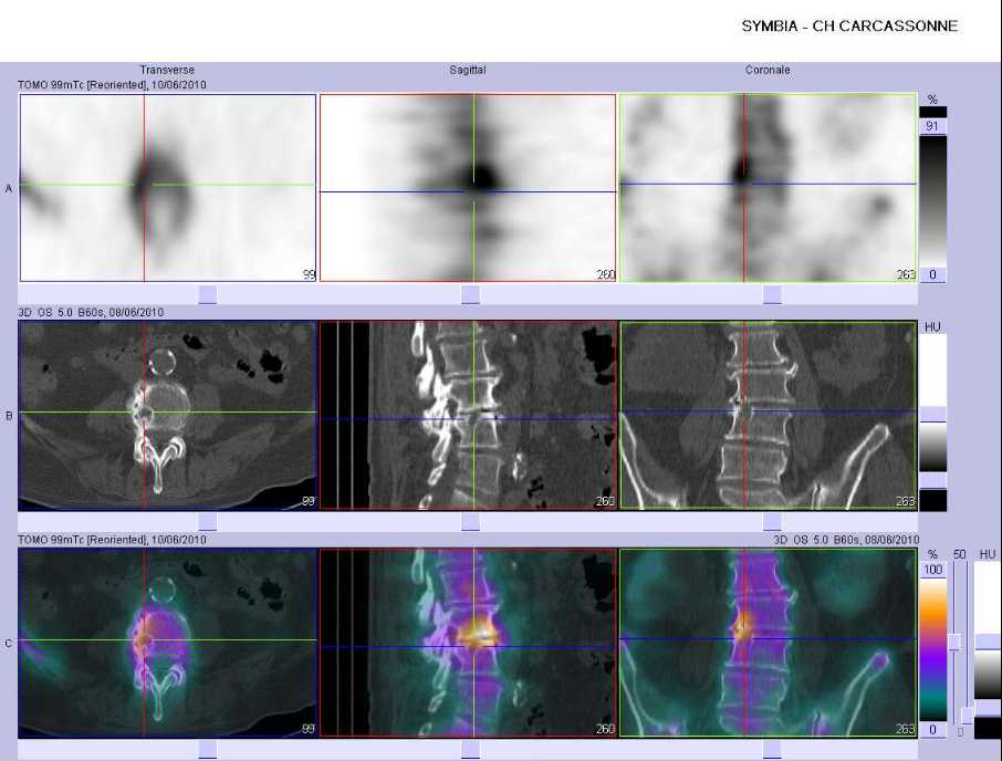 Discopathie arthrosique L3-L4, lat&eacute;ralis&eacute;e &agrave; droite