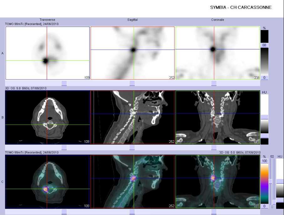 L&eacute;sion ost&eacute;ophytique marqu&eacute;e de la masse lat&eacute;rale droite de C4