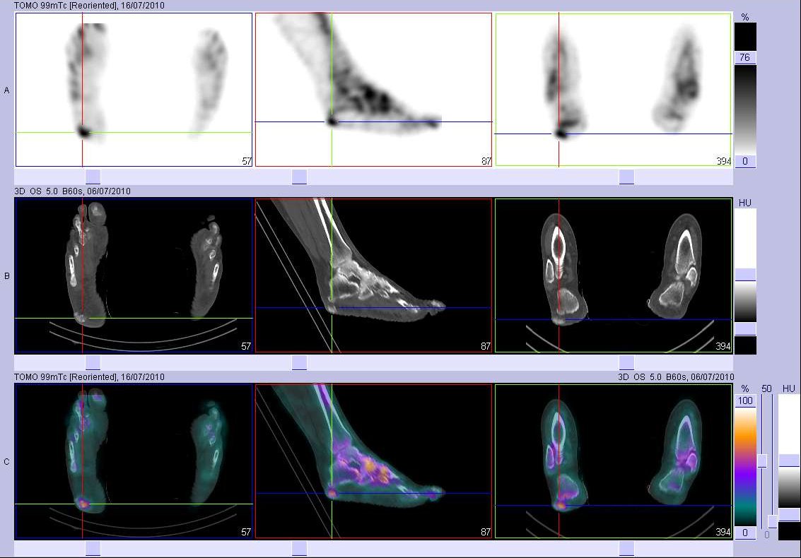 Calcifications sous-cutan&eacute;es du talon droit