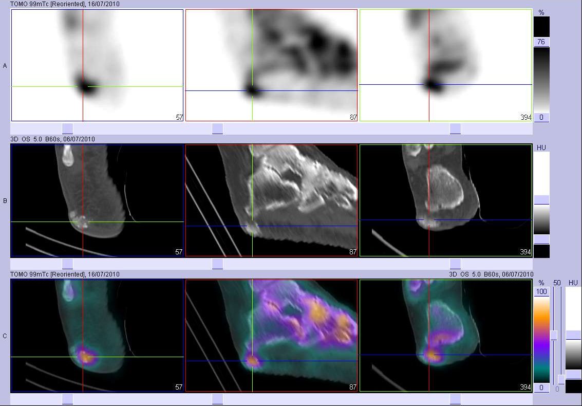 Calcifications sous-cutan&eacute;es du talon droit