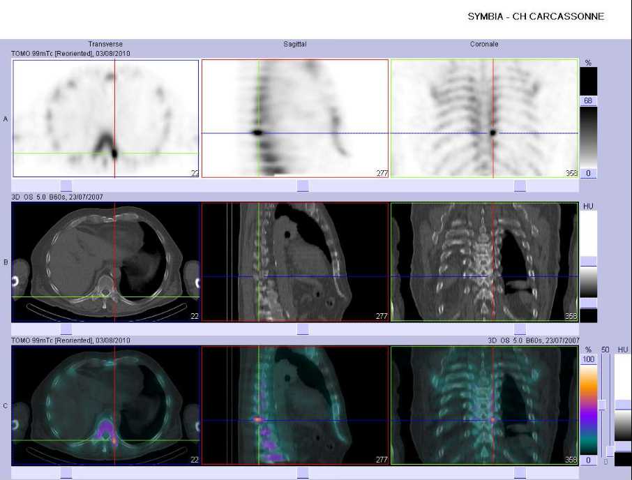 M&eacute;tastase ost&eacute;ocondensante au niveau de l'apophyse transverse gauche de T10