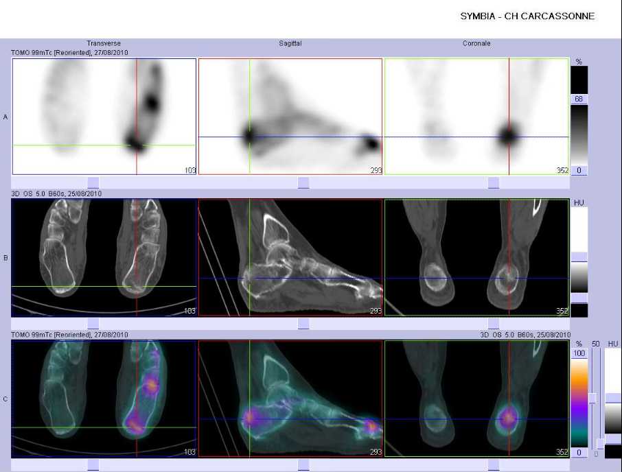 Fracture par insuffisance osseuse de la grosse tub&eacute;rosit&eacute; du calcaneus gauche