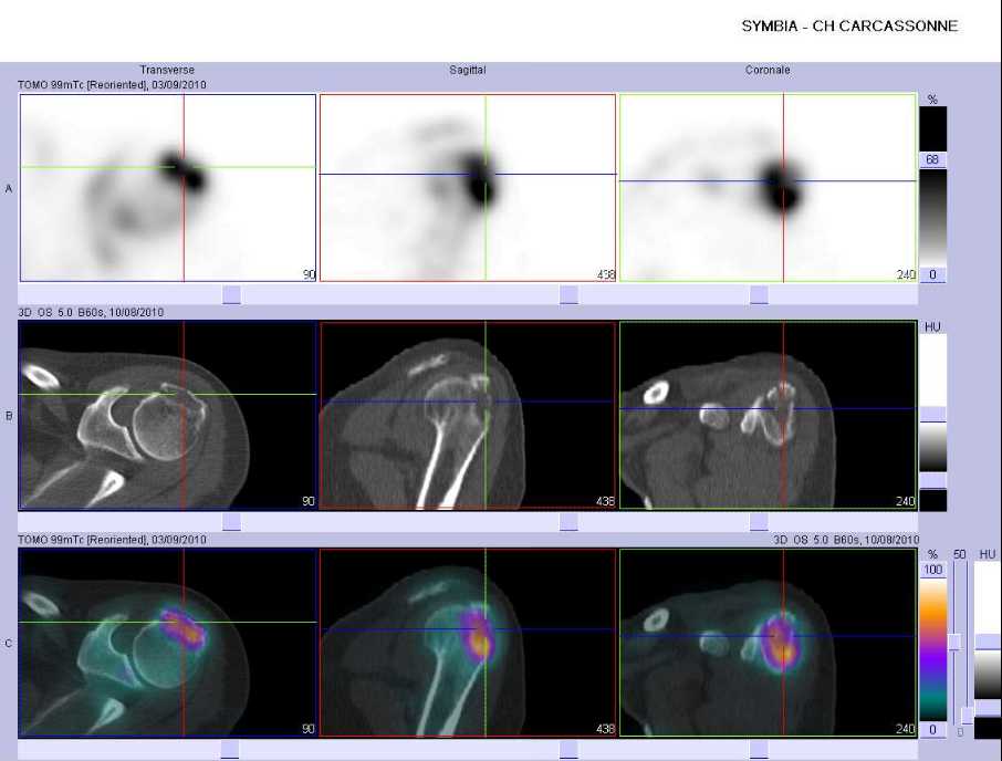 Fracture du tubercule majeur gauche