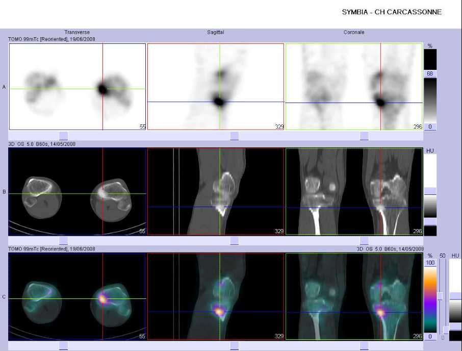 Fracture de fatigue du tibia