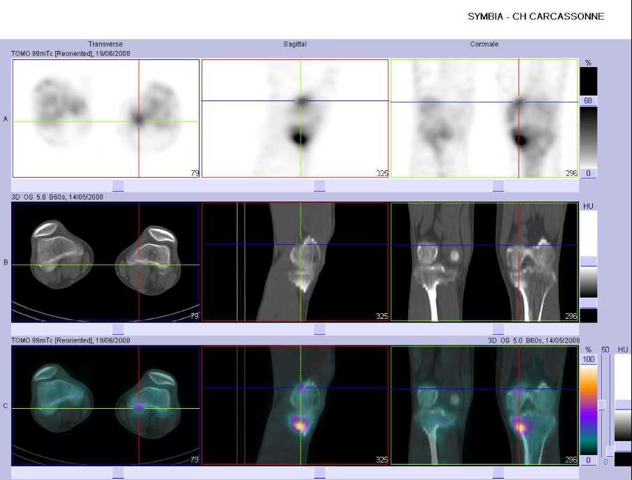 Pathologie d'insertion sus condylienne interne gauche
