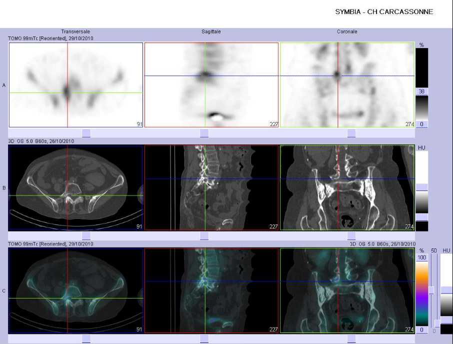 Fracture de l'apophyse transverse droite de L5